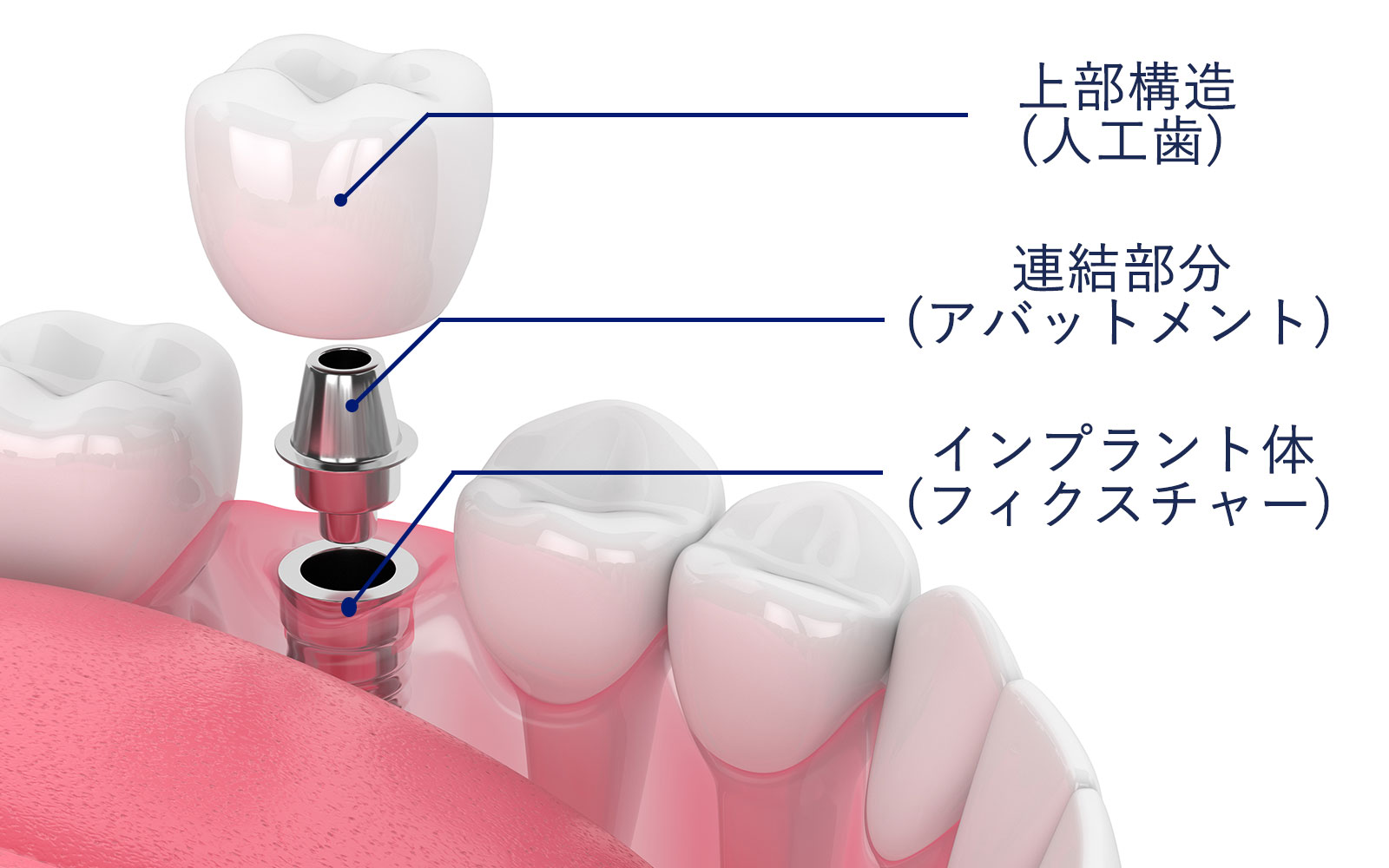 インプラントの構造