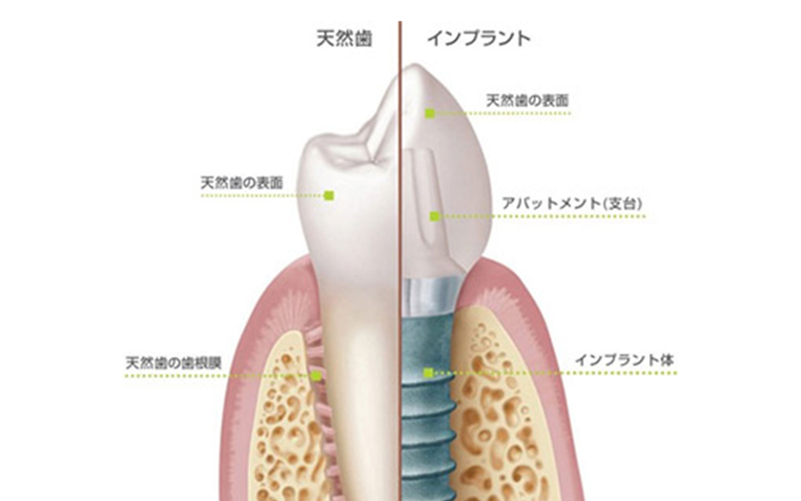 インプラントと天然歯の違い