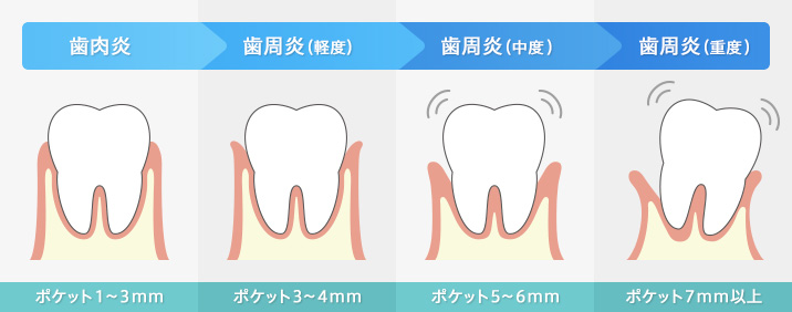 歯周病の進行表