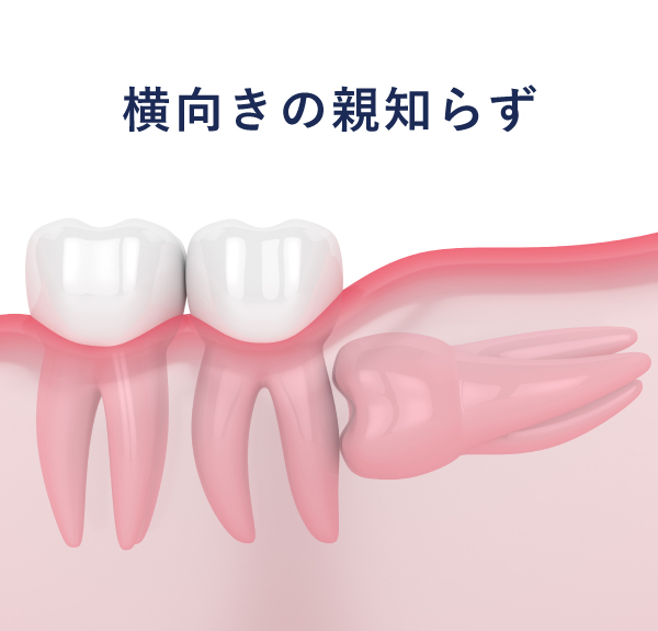 横向きの親知らず